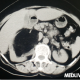 女性腰右侧刺痛，女性腰右侧刺痛像被针扎一阵一阵的