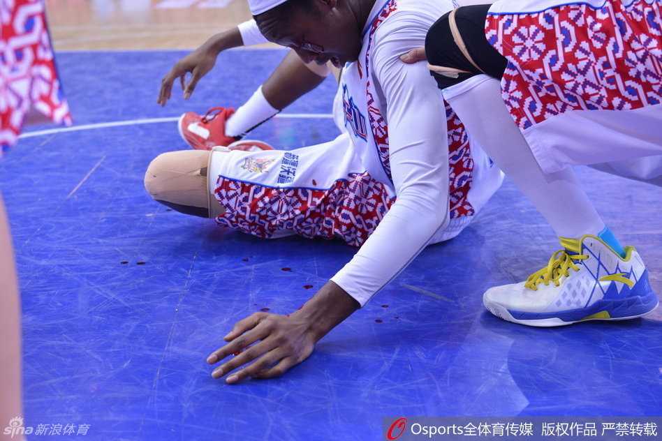 WCBA总决赛浴血战场:新疆外援查尔斯眼角开裂,用坚韧定义“新疆精神” 赛后,新疆队医为查尔斯的伤口进行清创和缝合,严重的伤势意味着她很可能缺席接下来的决战,但她已是球迷心中的英雄。